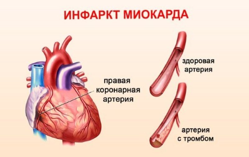 Здоровая и тромбозная артерии