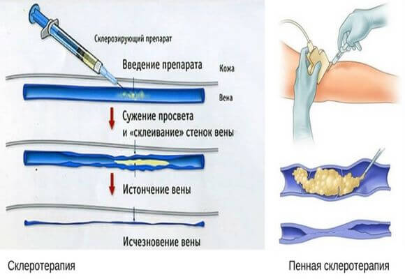 Склеротерапия варикозных вен