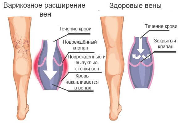 варикозное заболевание вен