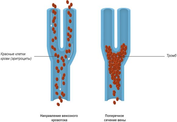 Схема венозного тромбоза