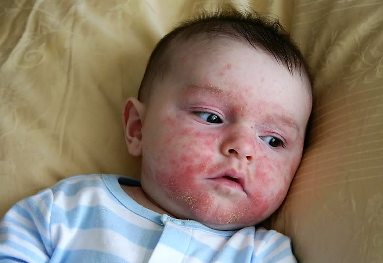 Аллергические пятна на лице у ребенка фото