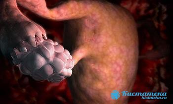 Папиллярная цистаденома арактеризуется сосочковыми разрастаниями в опуоли
