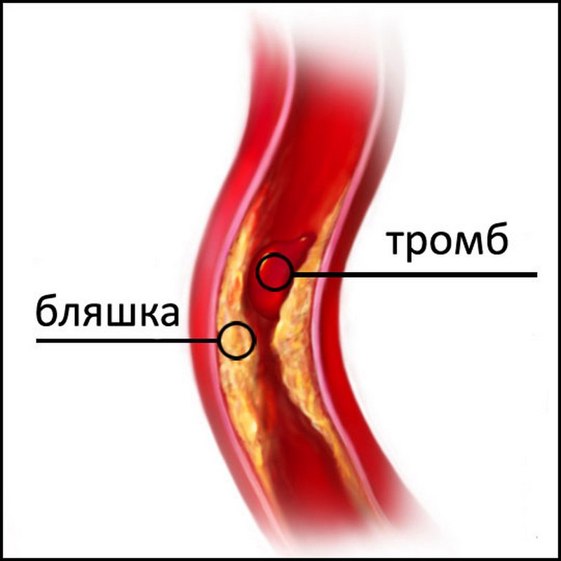 Чем отличается тромб. Атеросклероз бляшки сосудов. Атеросклеротические бляшки в сосудах образуются. Холестериновая бляшка в артерии.