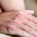 Противопоказание лазера при кожных болезнях
