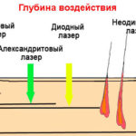 Глубина воздействия различных видов лазера
