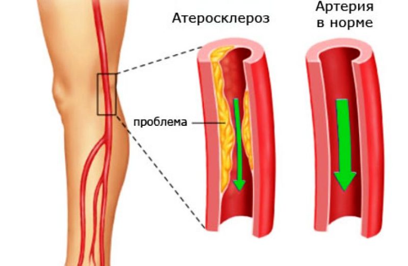 Атеросклеротическая артерия 