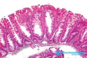 Зубчатая аденома под микроскопом