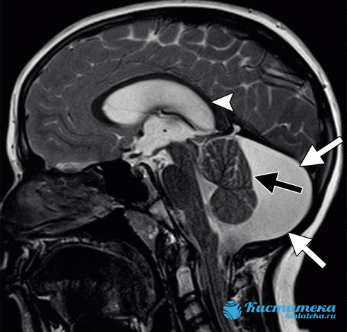 На изображении показана ретроцебеллярная араноидальная киста с явным увеличением задней ямки (белые стрелки)