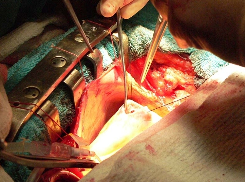 Операция на открытой грудной клетке 
