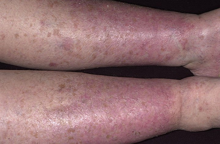 Осложнение ВРВ - варикозная экзема на ногах