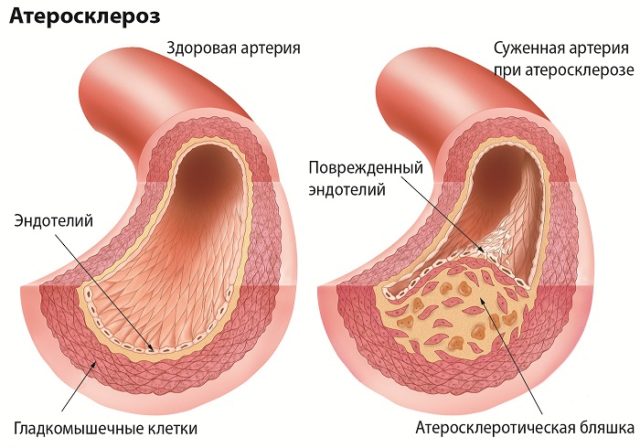 При атеросклерозе происходит поражение артерий во всех органах и тканях организма, на стенках артерий откладываются липиды (жиры, особенно холестерин) и соли кальция