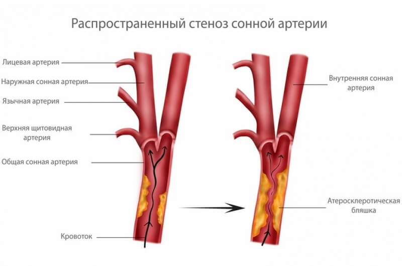 Стеноз сонной артерии