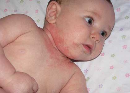 аллергия у ребенка