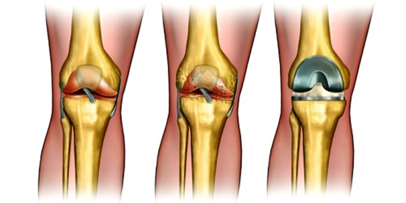 Артропластика коленного сустава 