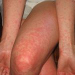 Опасность возникновения аллергии на крем с лидокаином