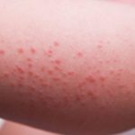 Раздражение кожи после эпиляции