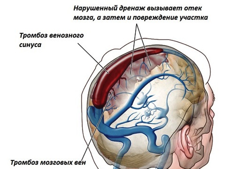 Тромбоз вен головного мозга 