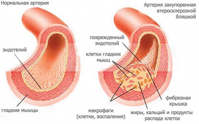 Артерия пораженная холестериновой бляшкой