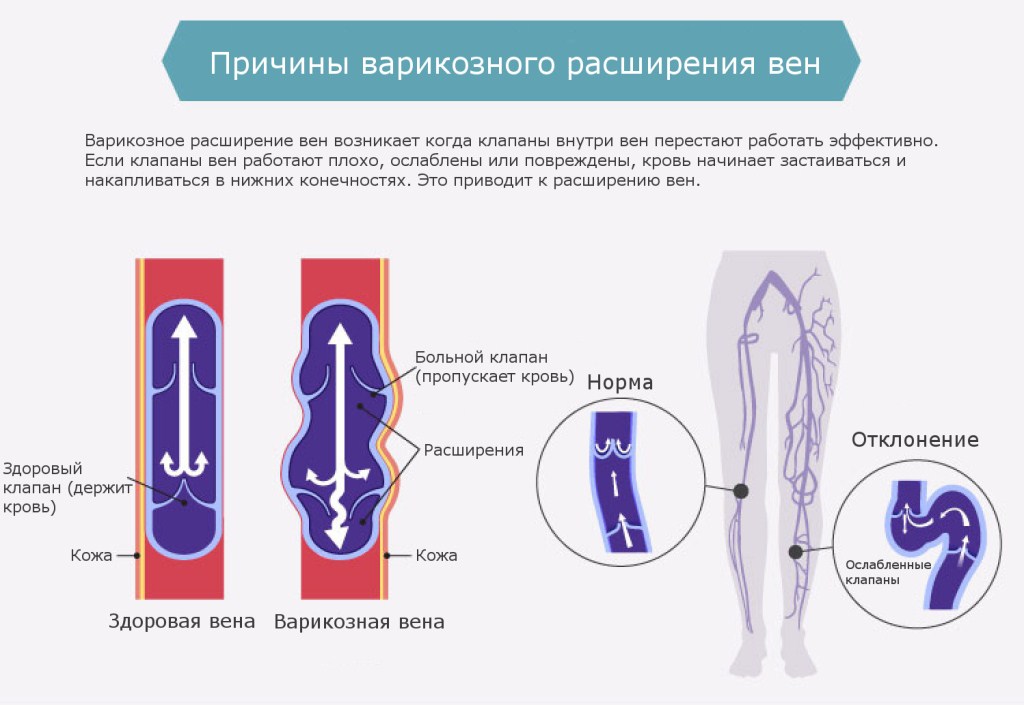 Факторы развития варикоза на ногах
