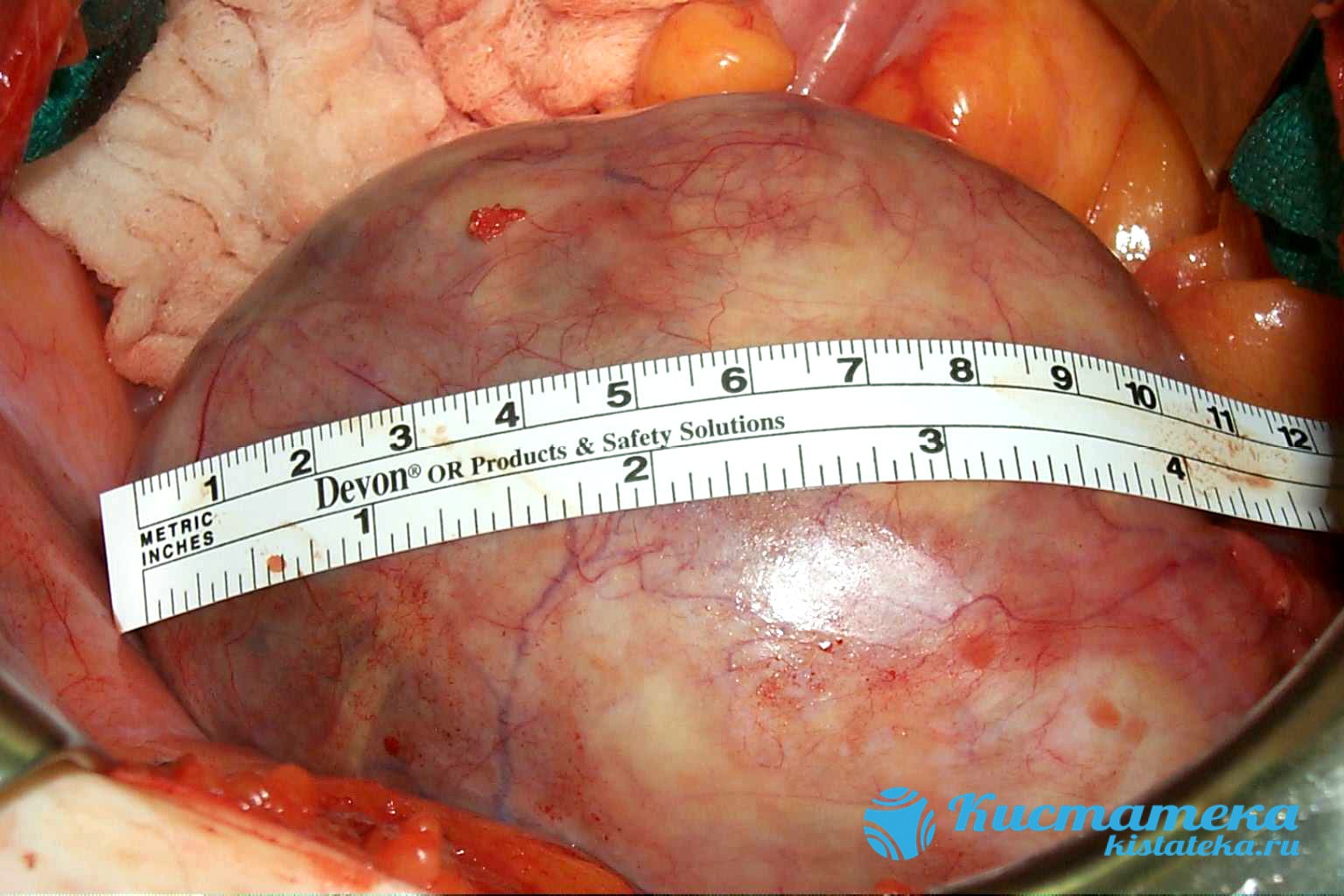 Новообразование дермоидного происождения содержит внутри толстостенную капсулу с жидким экссудатом и может достигать в диаметре 15 см
