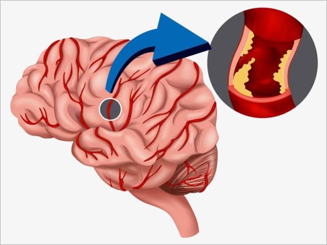 К хронической ишемии мозгового кровообращения могут привести и другие сердечно-сосудистые болезни