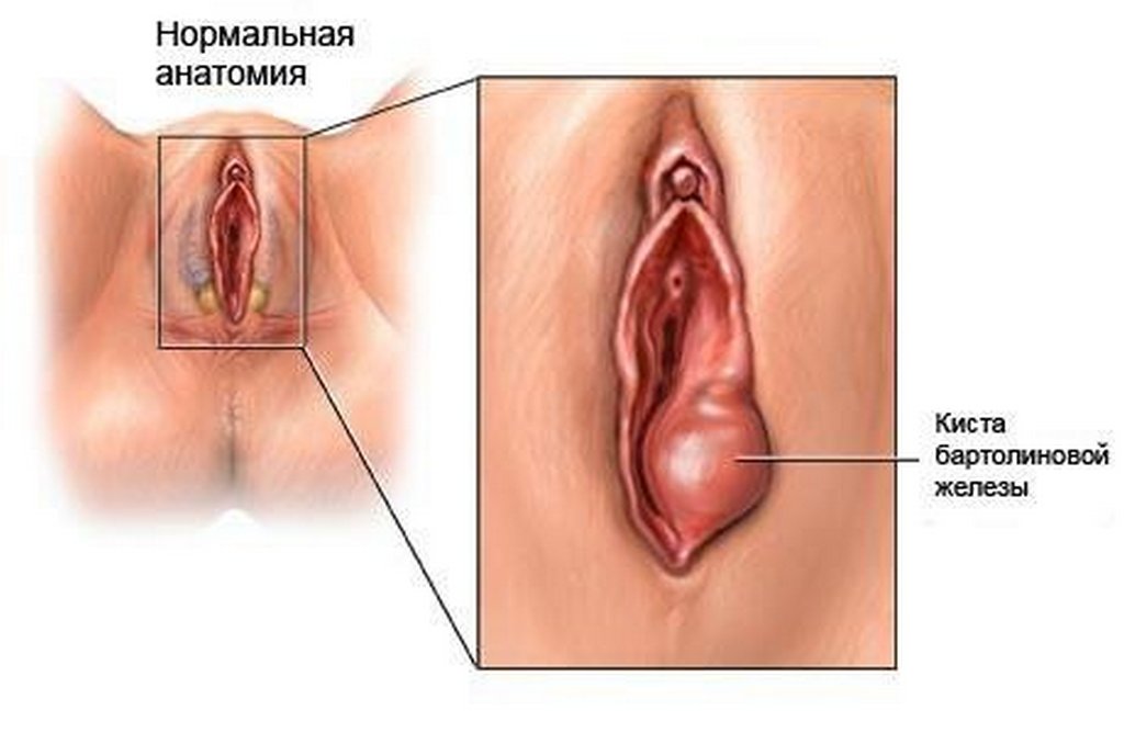 Варикоз половой губы