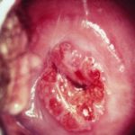 Плоскоклеточный рак шейки матки: описание заболевания, лечение и профилактика
