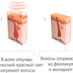 Принцип и схема действия эпиляции диодным лазером