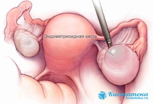 Беременность после удаления эндометриоидной патологии возможна с малой вероятностью