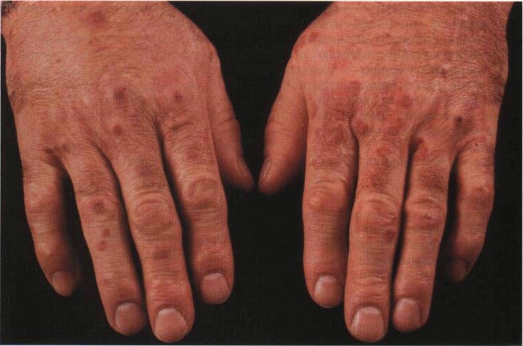 Болезненная красная сыпь на руках при ревматоидному васкулите