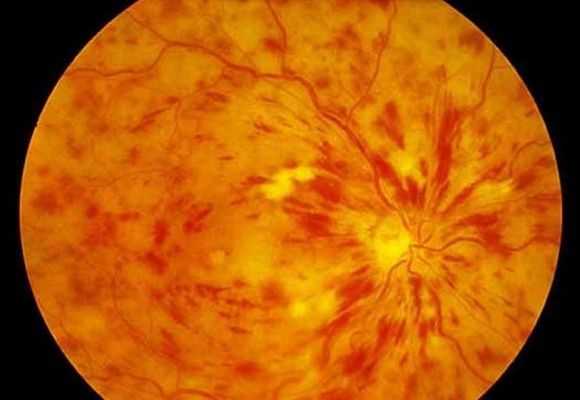 Заболевание центральной вены сетчатки глаза