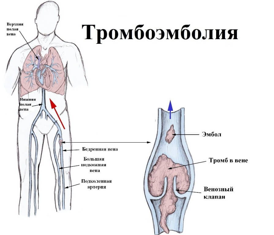 Причины развития тромбоэмболии