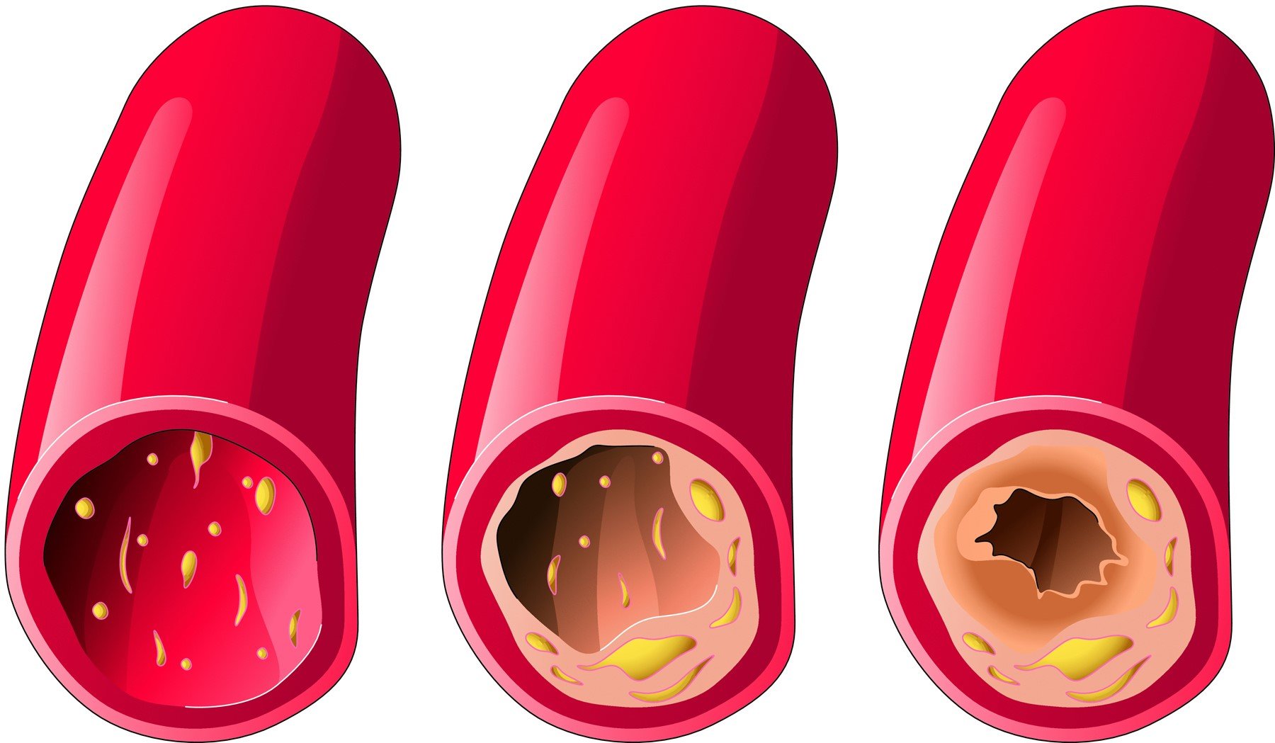 В брахиоцефальной артерии часто образуются холестериновые бляшки