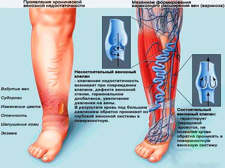 Пиявки на почки схема постановки