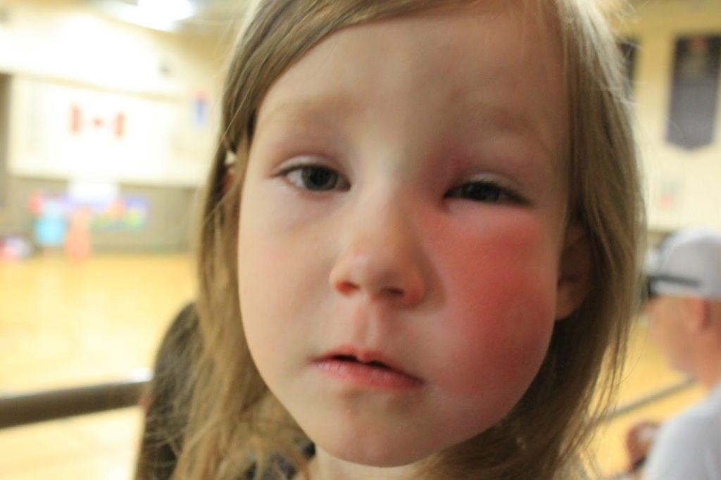 Аллергия на дрожжи у детей thumbnail