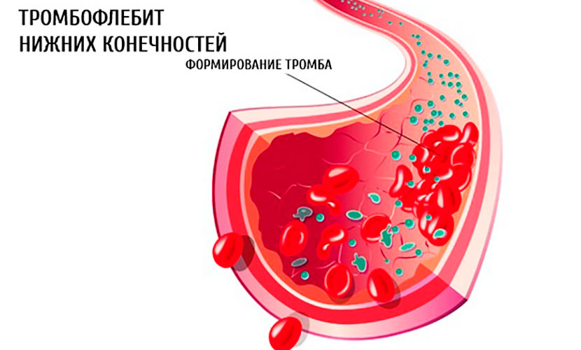 Коронавирус тромбы. Тромб в кровеносном сосуде.