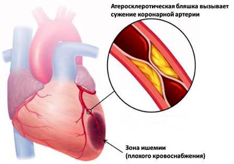 Ишемический участок сердца