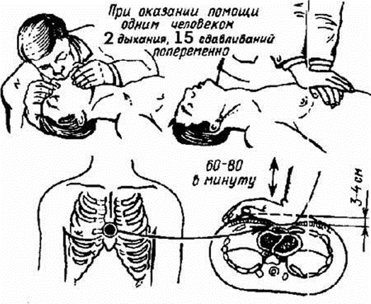 Схема наружного массажа сердца 