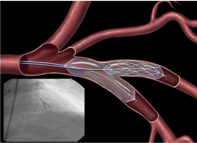 В таких случаях проводят реконструктивные операции на внутренних сонных артериях — каротидная эндартерэктомия, стентирование сонных артерий 