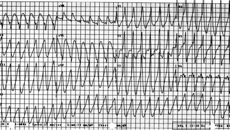 Кардиограмма желудочковой тахикардии