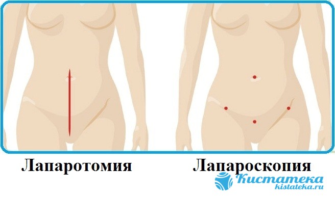  Есть два варианта доступа: лапаротомический (через разрез на животе) и лапароскопический (при использовании эндоскопического лечения)