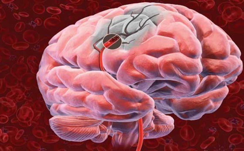 Хроническая ишемия головного мозга — что это такое?