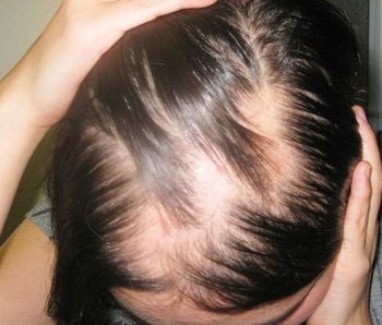 лечение выпадения волос у ребенка