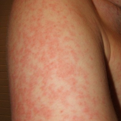 аллергия на коже