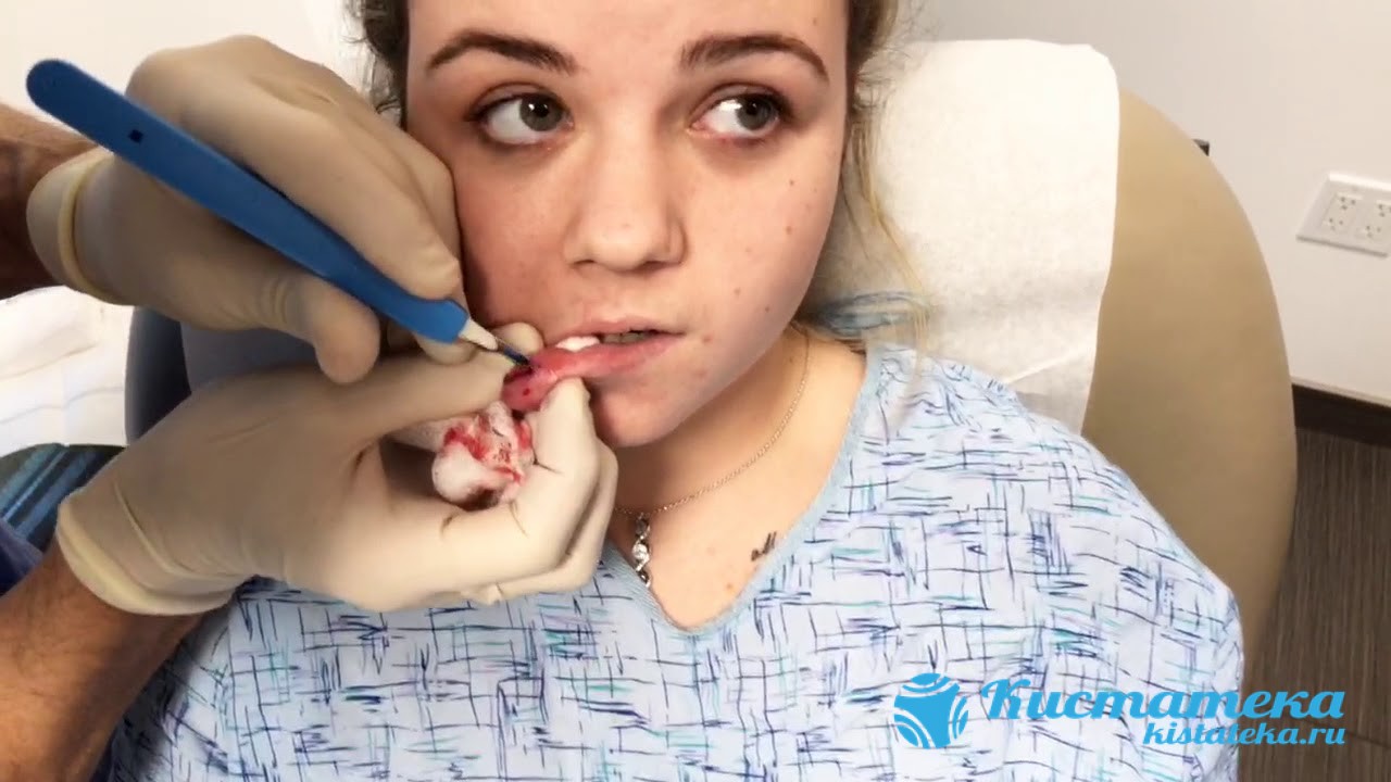 Новообразование на губе устраняют при помощи операции