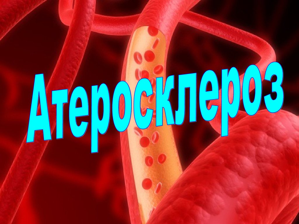 Атеросклероз сосудов — заболевание сосудов, характеризующееся их постепенной закупоркой атероматозными бляшками