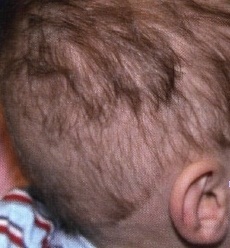 Почему у ребенка сильно выпадают волосы
