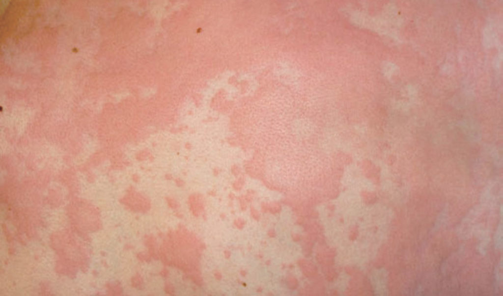 аллергия на коже