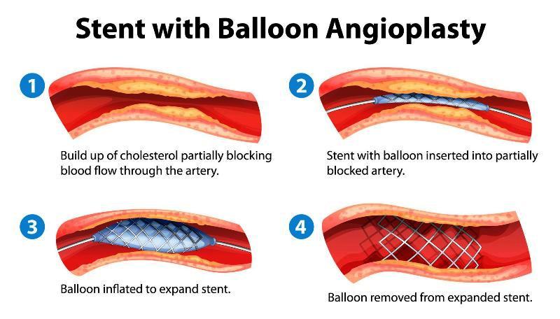 Балонная ангиопластика 