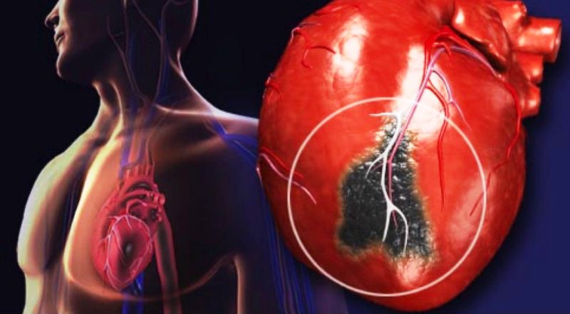 Зона пораженная инфарктом миокарда 